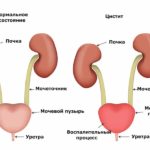 Сечо-статеві інфекції